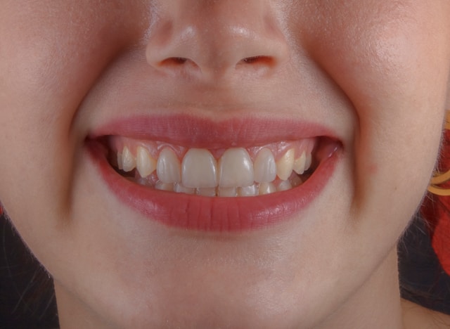 Ozkan guner 7mut2wmwtta unsplash Young Leaders why cosmetic dentistry can be life changing for some patients