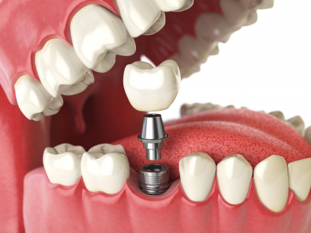 Model of lower jaw showing a dental implant being placed; abutment and crown component align with surrounding teeth (dental prosthetic procedure).