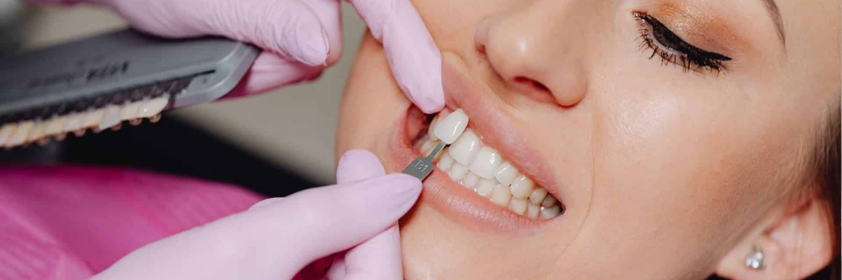 How Long Do Dental Veneers Last, And What Really Affects Their Lifespan?