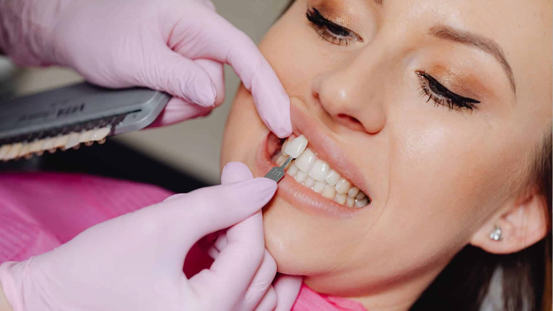 how long do dental veneers last and what really affects their lifespan
